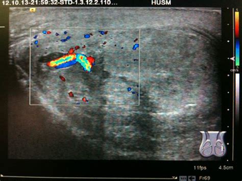 Color Doppler Ultrasound demonstrating normal Doppler signal on... | Download Scientific Diagram