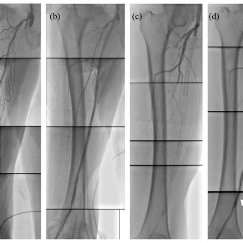 Fogarty catheter with filled balloon to retract thrombus. | Download ...