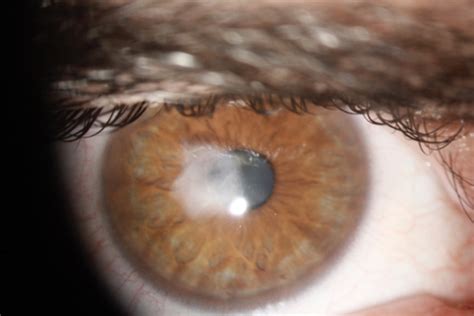 Corneal Scarring — QEI Laser · Laser Eye Surgery · Queensland Eye ...