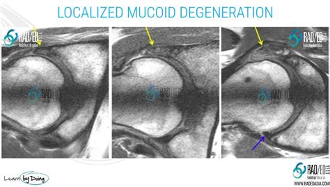 Hip Acetabular Labrum Mri More Than Just Tears Mucoid Degeneration