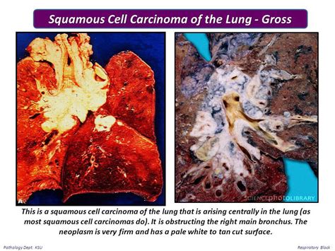 Squamous Cell Carcinoma Lung Gross