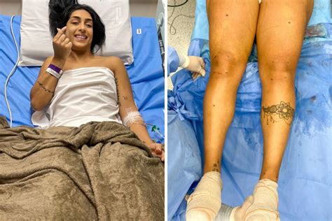 Ex BBB Amanda Djehdian faz cirurgia de lipedema Saiba o que é