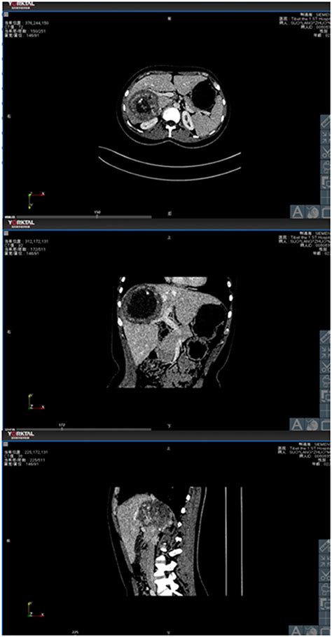 Frontiers The Application Of Preoperative Three Dimensional