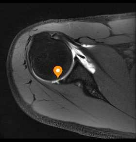 Articular surface of humeral head - e-Anatomy - IMAIOS