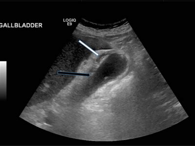 Ultrasound Scan for Gallbladder | Medintu