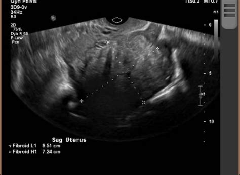 Hysteroscopy : r/Fibroids