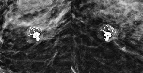 Popcorn Calcification Breast Image