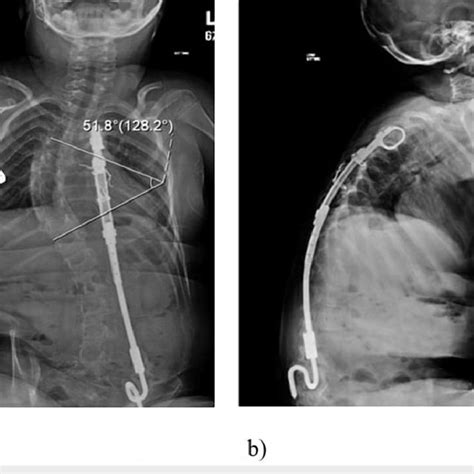 Plain Radiographs At Final Follow Up A A P Radiograph Of The Patient