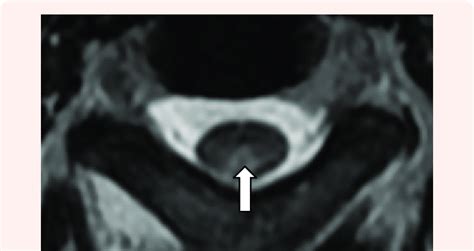 Mri Cervical Spine T Weighted Image Axial View Showing Hyperintense