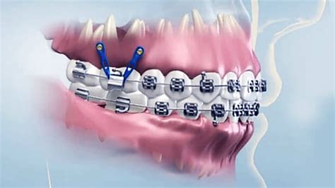 Microtornillos en Ortodoncia qué son y para qué se usan Clínica Pfaff