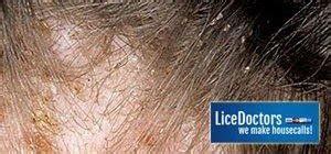 What Are the Symptoms of Lice?