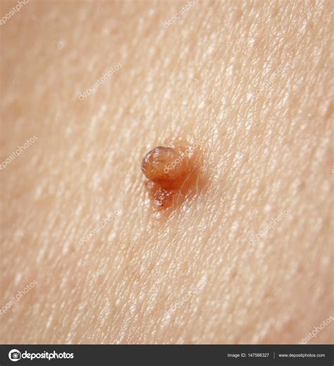 Human Skin With Birthmark — Stock Photo © Belchonock 147566327