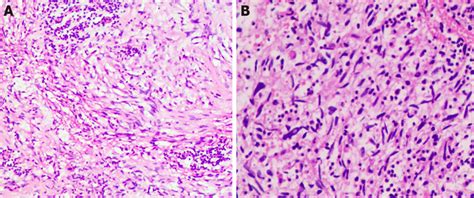 Histopathological Findings Of Inflammatory Myofibroblastic Tumor A