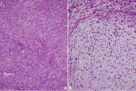 Histopathologic Examination Magnification 200× Revealed A Ovoid Or