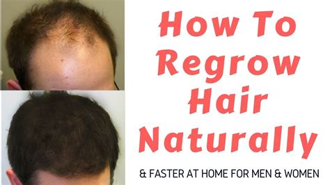 How To Regrow Hair Naturally And Faster Hair Loss Treatment For Men And Women Youtube