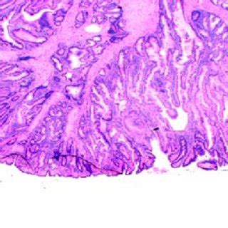 Base of hamartomatous polyp with mucin extravasation and glandular... | Download Scientific Diagram