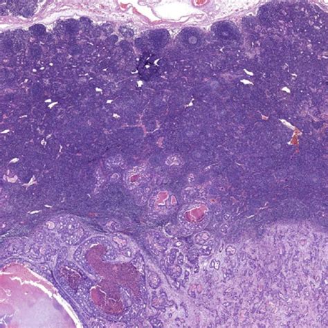 Pathological Image Of Lymph Node Metastasis 20× Download Scientific Diagram