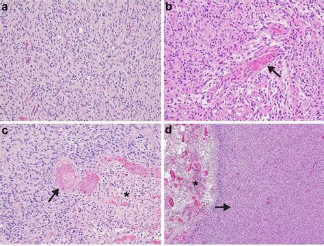 Histopathology Of Glioma Progression Hande Staining Diffusely