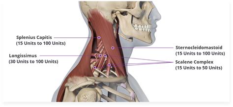 Cervical Dystonia Pain