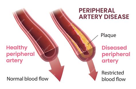 Ilustração Do Vetor Infográfico De Doença Arterial Periférica Vetor