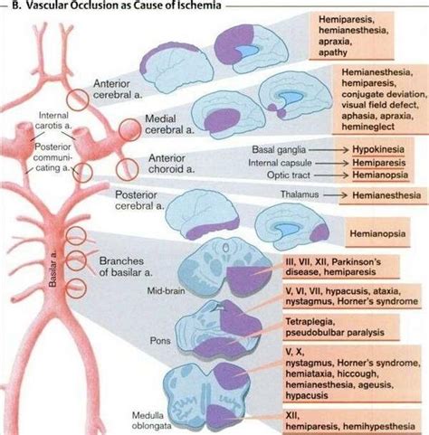 Síntomas Relacionados Con Lugar De Oclusión De Arterias Cerebrales