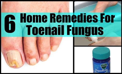 Cure Fungal Nail Infection Home Remedies – Yeast Infection Tips