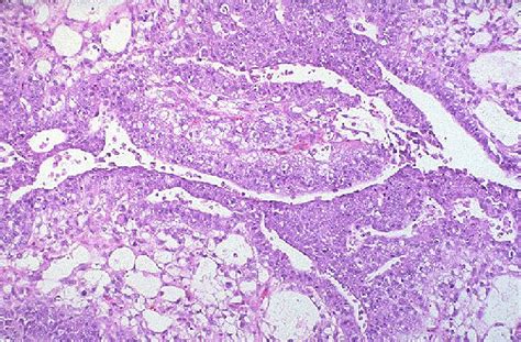 Pathology Outlines Yolk Sac Tumor