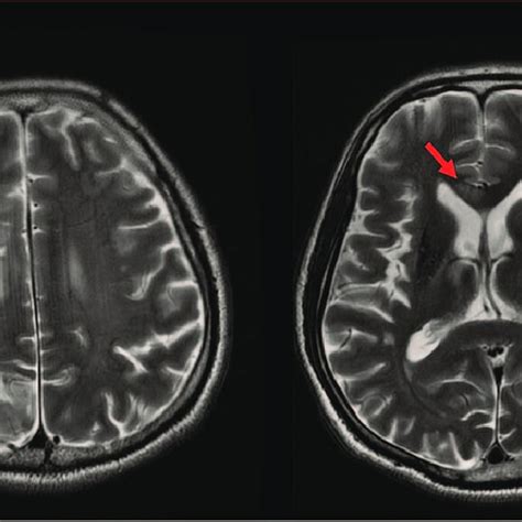 T2 Weighted Axial Brain Magnetic Resonance Images Show Subacute To