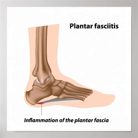 Foot Problem Plantar Fasciitis Poster Zazzle