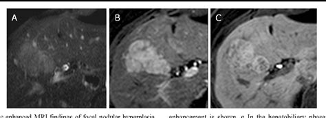 Gadoxetic Acid Enhanced Mri For Differentiation Of Fnh And Hca A