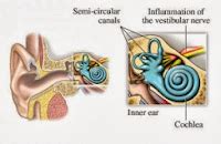 Neuronitis Vestibularis symptoms causes treatment | Share All Knowledge