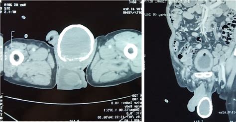 eggshell calcification   case  longstanding hydrocele bmj case