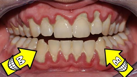 Rem Dios Caseiros Para Eliminar Completamente O T Rtaro Dos Dentes