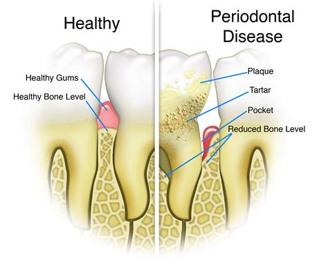 What Are The Causes And Treatment For Periodontal Disease