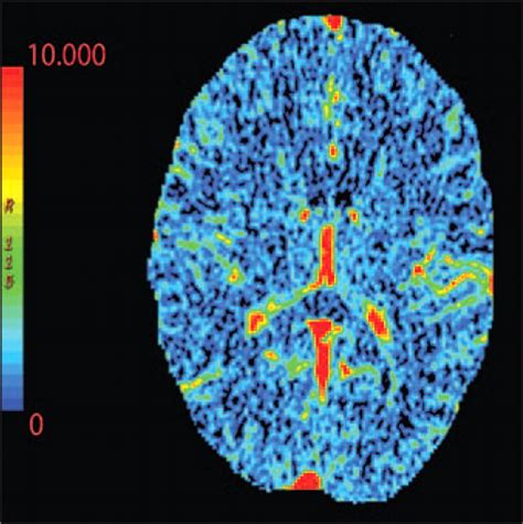 Imaging Of Stroke Part 1 Perfusion Ctoverview Of Imaging Technique