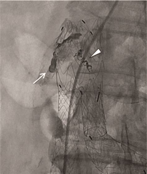 Embolization Of A Type Ii Endoleak With Interlock™ 18 Coils