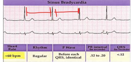 EKG And Arrhythmia 6 Flashcards Quizlet