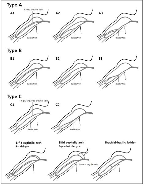 Figure 1 From Anatomical Variants Of Upper Arm Veins On Preoperative Mapping Venography For