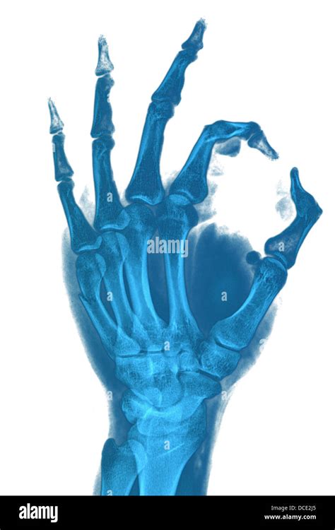 Hand Xray Image Medical Background Stock Photo Alamy