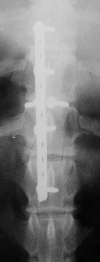 Postoperative Radiograph Showing Position Of Implants Download