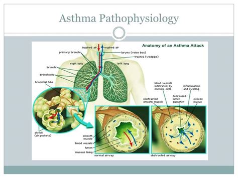 Ppt Asthma Powerpoint Presentation Id2052046