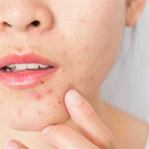 What Is Skin Purging And How Is It Different From A Breakout Experts