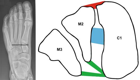 File Lisfranc Ligaments Physiopedia