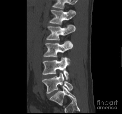 Spondylolysis Photograph By Medical Body Scans Fine Art America