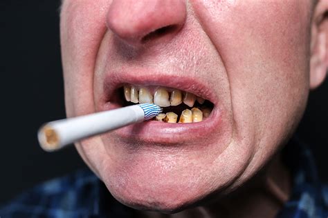 Effect Of Smoking On Nonsurgical Periodontal Therapy ODHA Dental