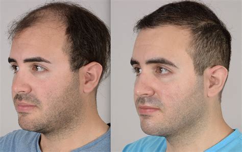 Hair Transplant Photos Katona Hair Transplants Florida