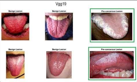 Table 1 From Automated Detection Of Oral Pre Cancerous Tongue Lesions Using Deep Learning For