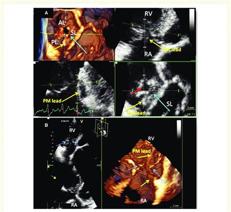 Three Dimensional Echocardiographic View Of The Right Atrium And The