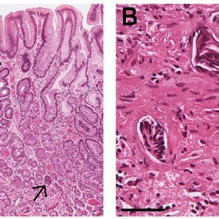 Cancer In The Setting Of Md A Low Power View Showing Typical Features