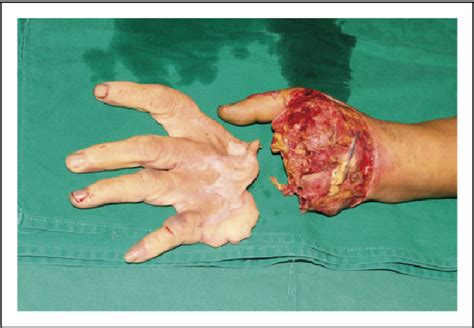 Figure From The Use Of A Free Groin Flap To Reconstruct A Dorsal Hand